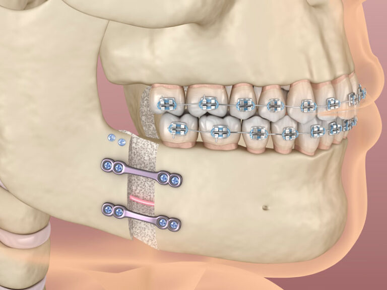 CBMT-1