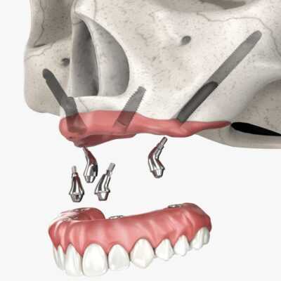 odontologia-e-implantes-allon