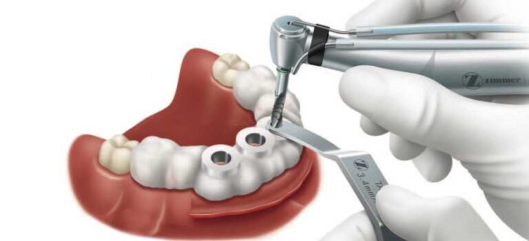 odontologia-e-implantes-cirurgia-guiada1