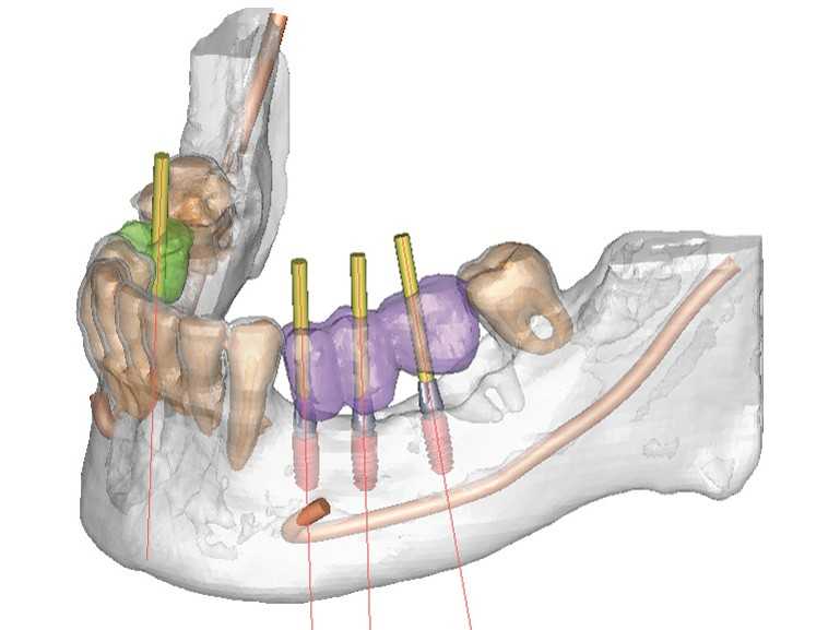 odontologia-e-implantes-cirurgia-guiada24